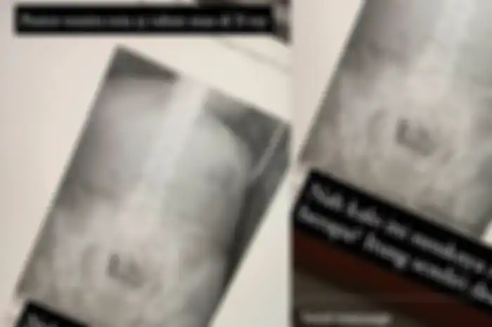 Ratusan susuk terlihat pada x-ray pasien wanita usia 55 tahun.
