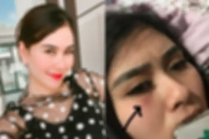 Syahnaz Sadiqah tetiba pamer potret menangis, mata bagian bawah bengkak dan memar, ada apa?