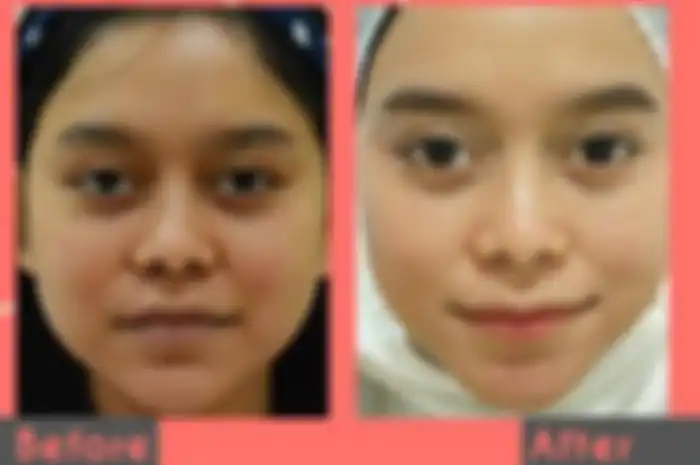 Foto before dan after Lesti Kejora.