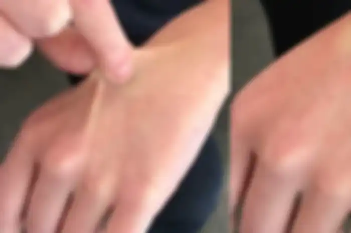 Cubit punggung tangan