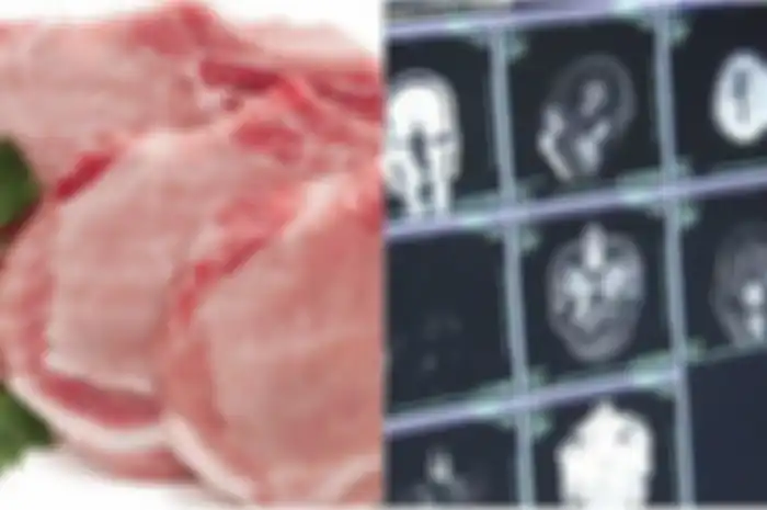 Dokter menemukan banyak cacing pita di otak remaja ini