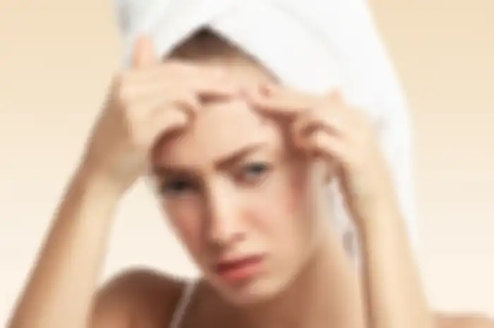 5 Tips Mengatasi Jerawat Pada Kulit Kering Menurut Ahli Dermatologi