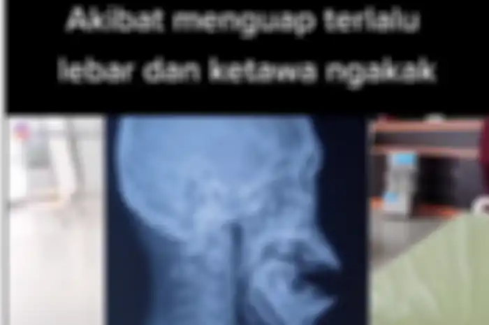 Menguap terlalu lebar sebabkan dislokasi rahang