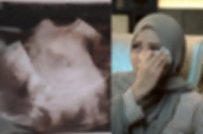 Aurel Hermansyah keguguran