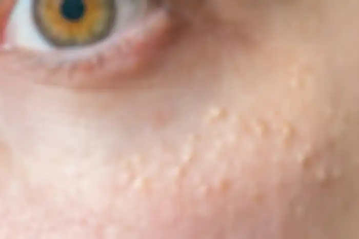Skincare untuk atasi milia pada kulit sekitar mata.