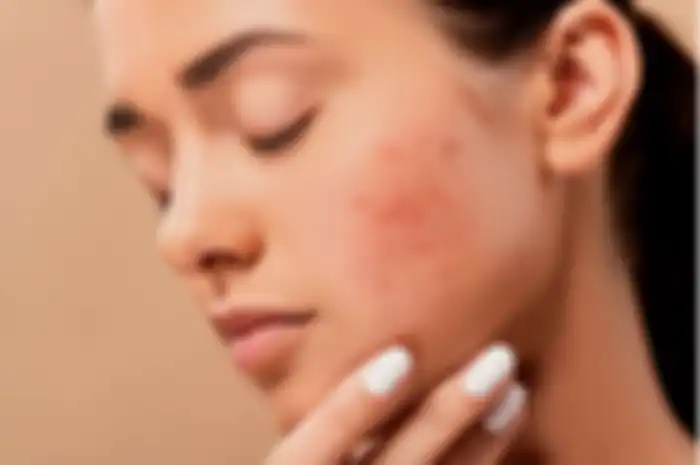 Ilustrasi skin barrier rusak