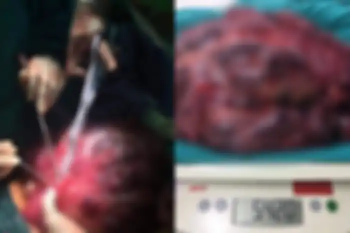 Dokter temukan tumor seberat 5 kg dari perut pria ini