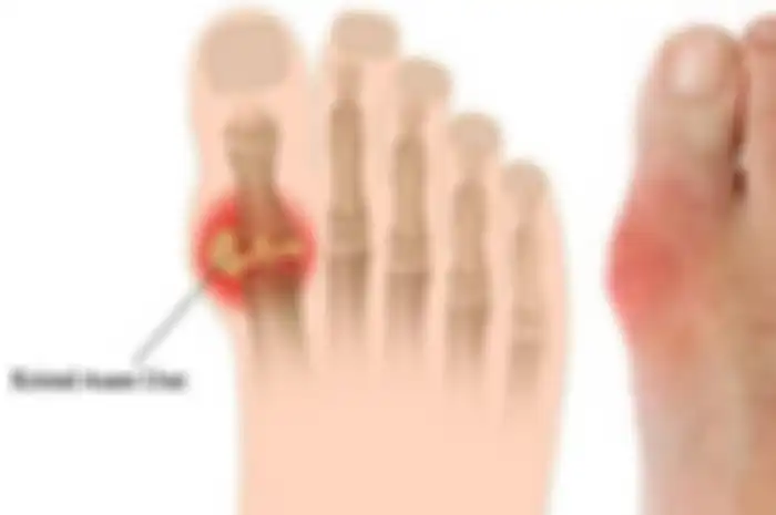 Ilustrasi asam urat yang terjadi pada kaki. Ternyata hal ini bisa diatasi dengan mengonsumsi air rebusan daun sukun