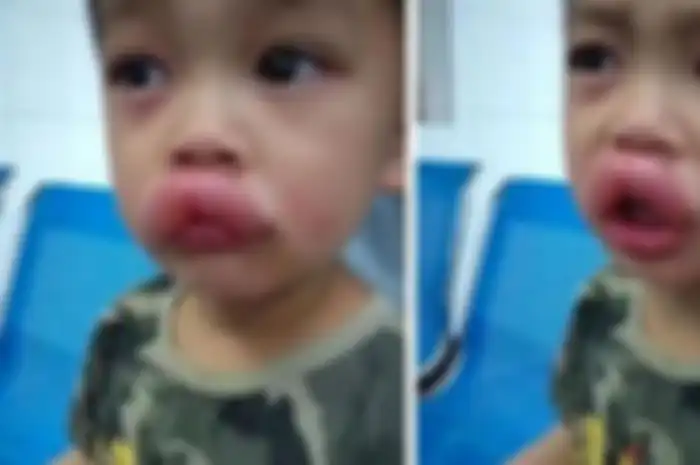 Bibir anak bengkak parah karena makan anggur