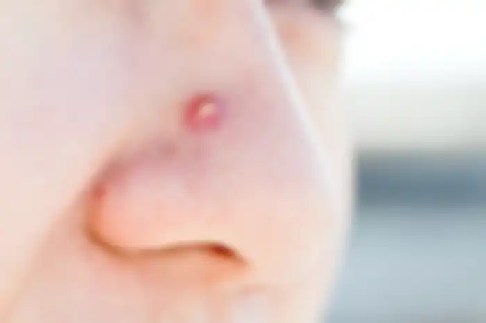 Ilustrasi jerawat di hidung