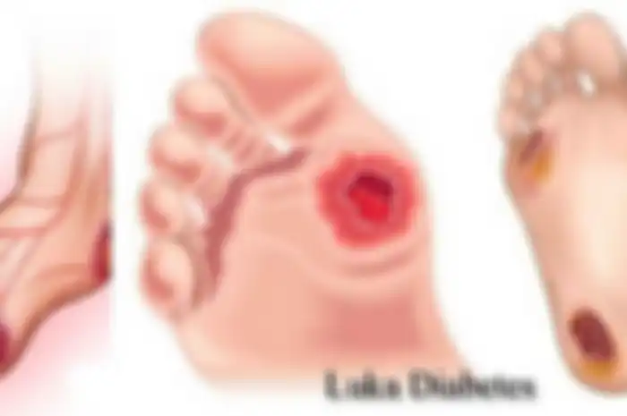 penderita diabetes rawan terkena masalah kaki