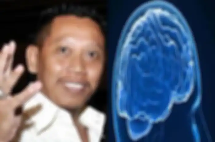 Tukul Arwana alami pendarahan otak.