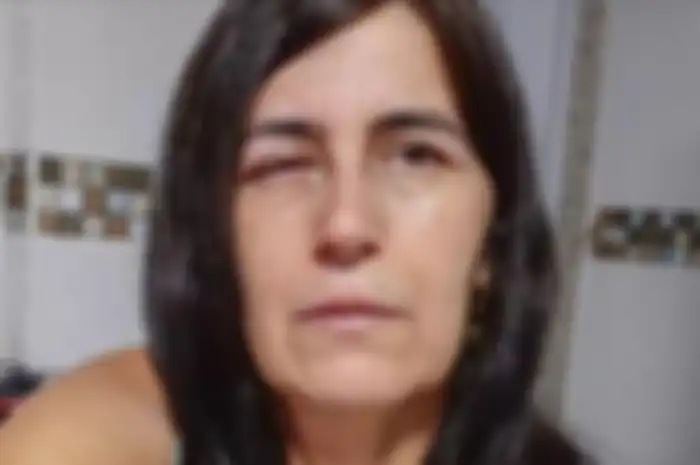 Regina Amorim, seorang wanita di Brasil yang harus dilarikan ke rumah sakit setelah matanya ditetesi lem super kuat oleh pacarnya.