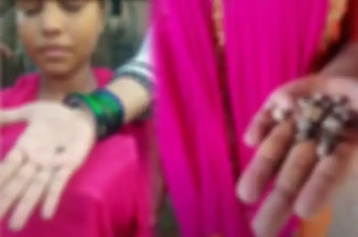 Chandhi, gadis 15 tahun di Negara Bagian Uttar Pradesh, India, yang menjadi viral karena mengeluarkan batu, alih-alih air mata