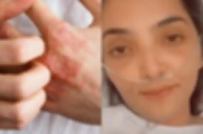 Ashanty didiagnosa autoimun