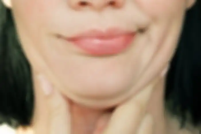 Ilustrasi double chin alias dagu berlipat. 