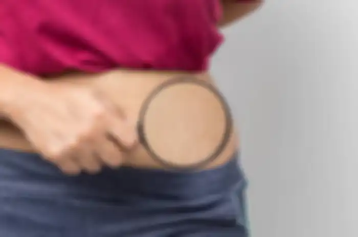 Ilustrasi stretch mark 