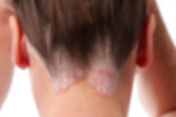 Covid-19 lebih berbahaya pada pasien psoriasis