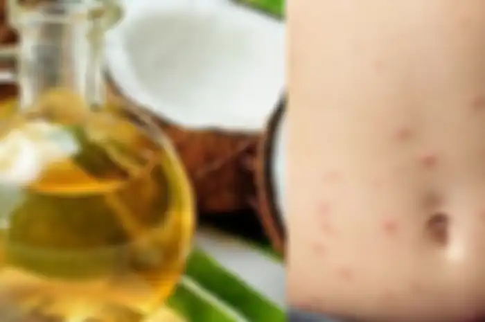 Penyebab jerawat di perut dan cara mengatasinya dengan bahan alami.