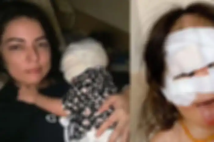 Kondisi Bayi Luna saat dioperasi, wajahnya diperban 