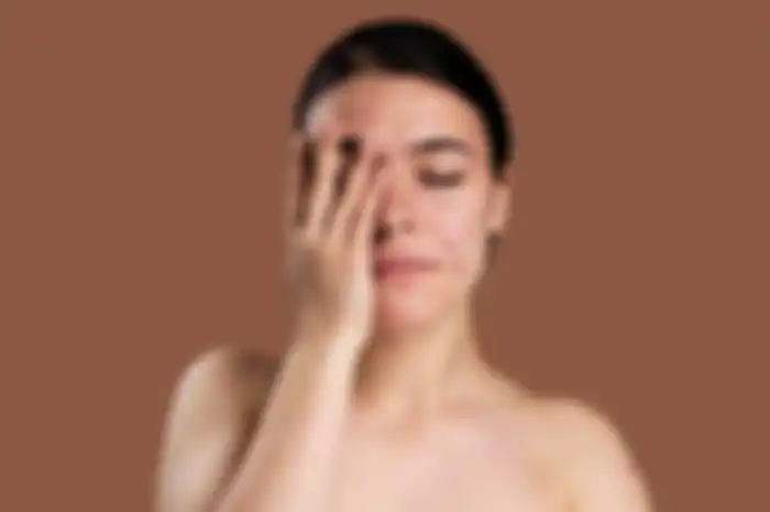 Ilustrasi jerawat 