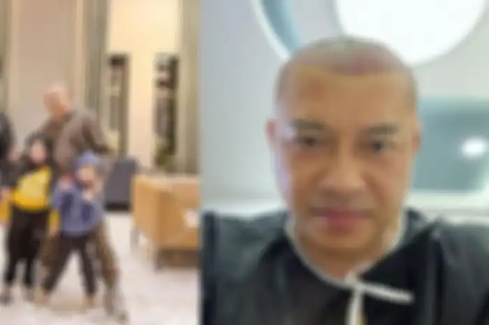 Anang Hermansyah transplantasi rambut