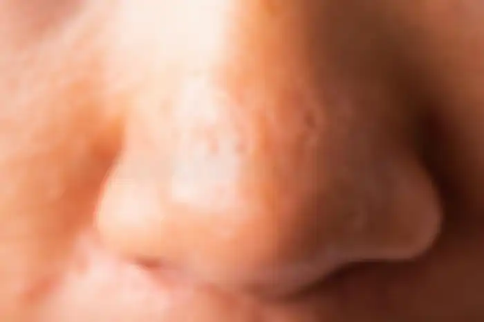 Ilustrasi pori besar di hidung