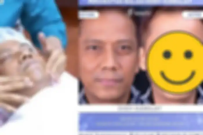 Ogah kalah glowing seperti Mayang, begini wajah Doddy Sudrajat setelah perawatan Rp 80 juta.