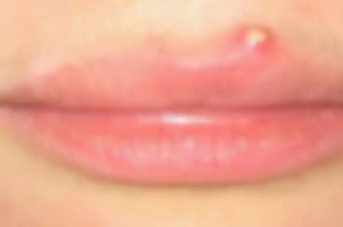 jerawat di bibir