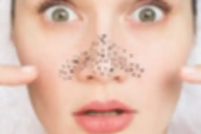 Ilustrasi komedo di hidung