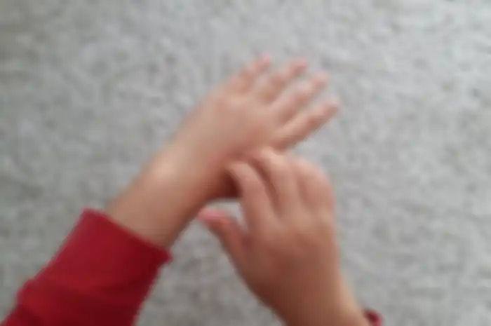 Biduran pada anak 