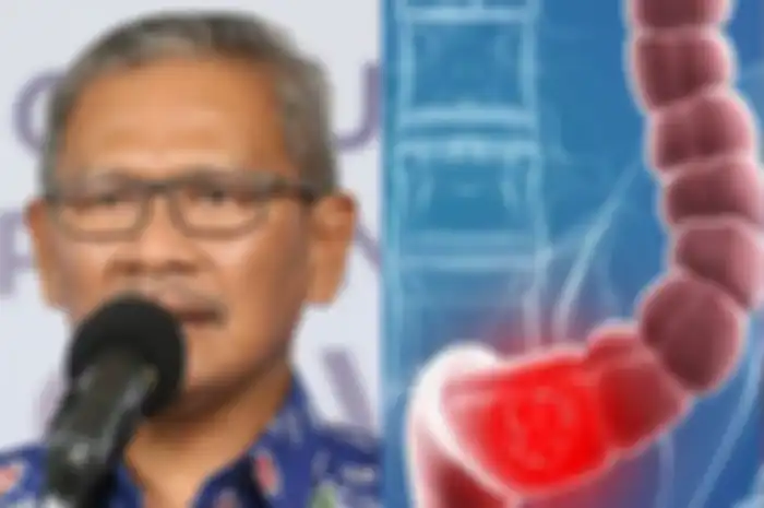 Achmad Yurianto dan kanker usus