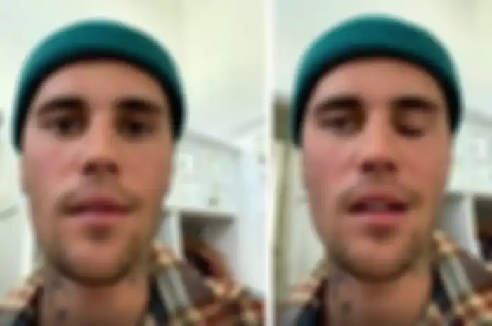 Justin Bieber menderita kelumpuhan wajah akibat sindrom Ramsay Hunt.