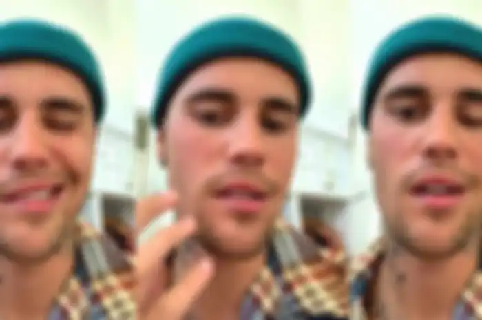 Wajah Justin Bieber lumpuh karena sindrom Ramsay Hunt.