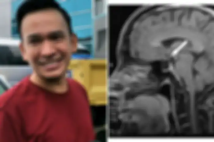 Ruben Onsu didiagnosis mengidap Penyakit Empty Sella Syndrome