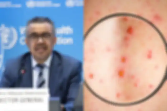 WHO menetapkan wabah cacar monyet atau monkeypox sebagai keadaan darurat kesehatan global