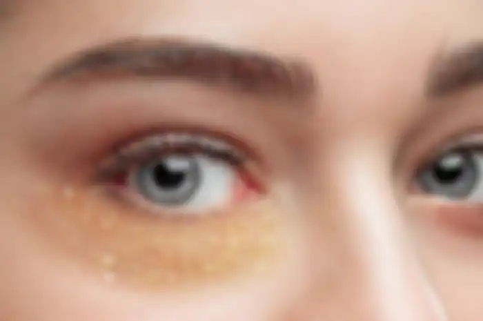 Ilustrasi milia di bawah mata disebabkan oleh eye cream