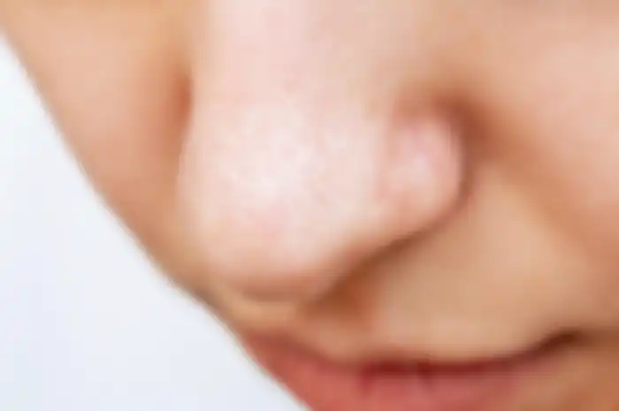 Ilustrasi pori besar di hidung