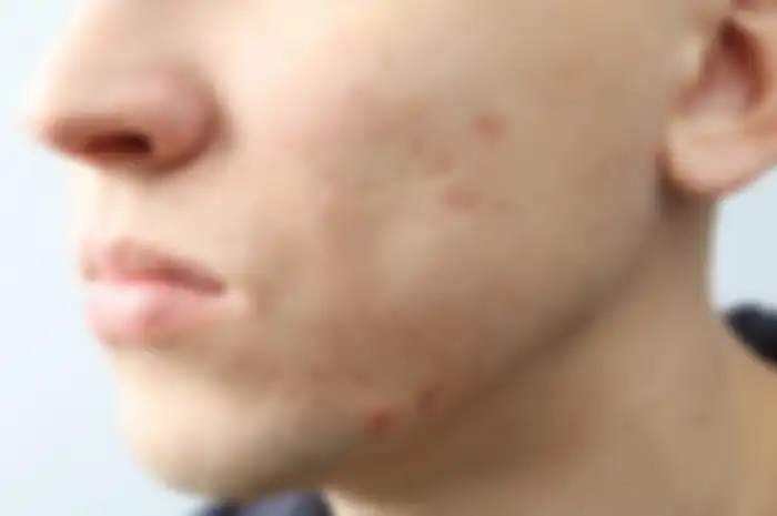 Aneka Tips Kecantikan, Cara Menghilangkan Bopeng Bekas Jerawat