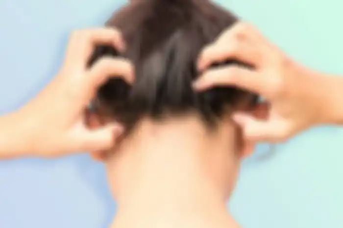 Tips mengatasi psoriasis di kepala
