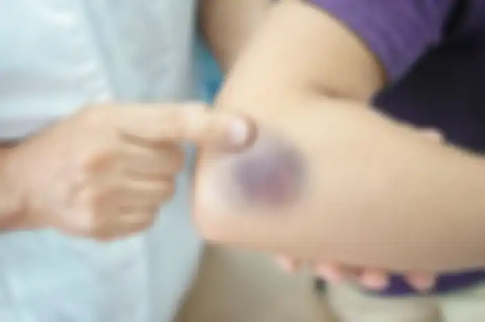 Penyebab memar muncul di kulit tiba-tiba tanpa alasan
