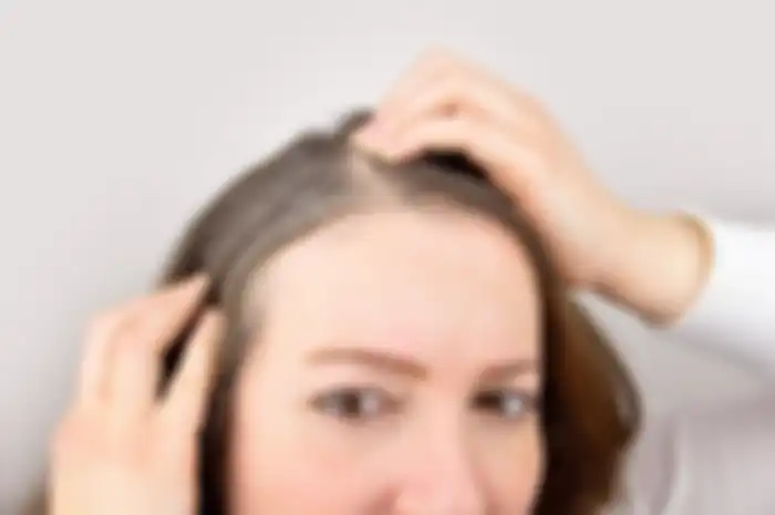 Uban di rambut mending dihilangkan dengan modal 1 bahan ini saja.