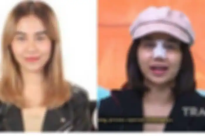 Mayang operasi hidung