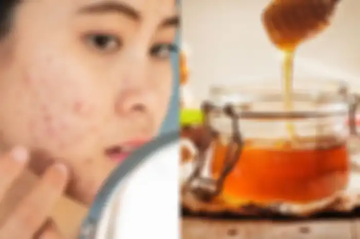 Cuma modal madu bisa hempaskan bopeng di wajah