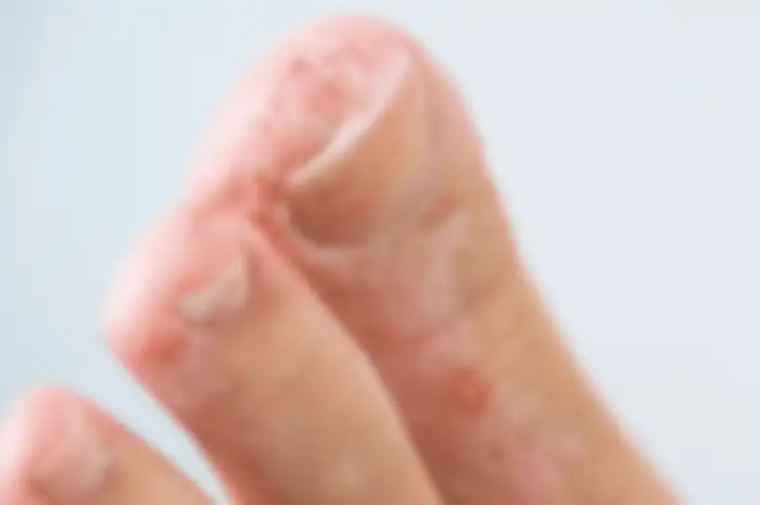 Tips hidup cara menghilangkan kutu air dengan obat alami