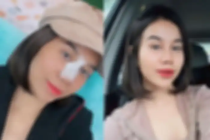 Mayang Lucyana puas dengan hasil operasi hidung yang dilakukannya.