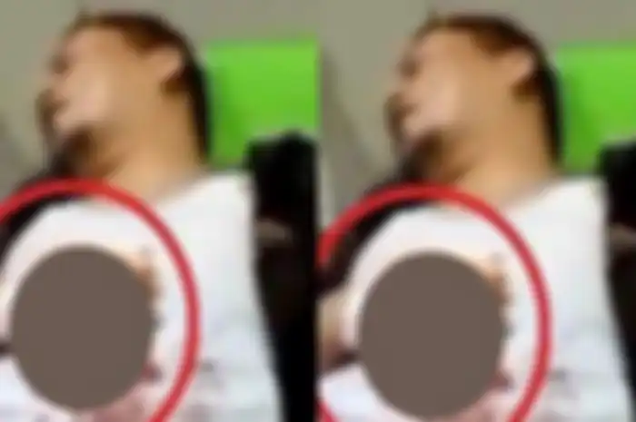 Jari Wakil Bupati Kaur, Herlian Muchrim terluka parah karena terkena ledakan kembang api. 