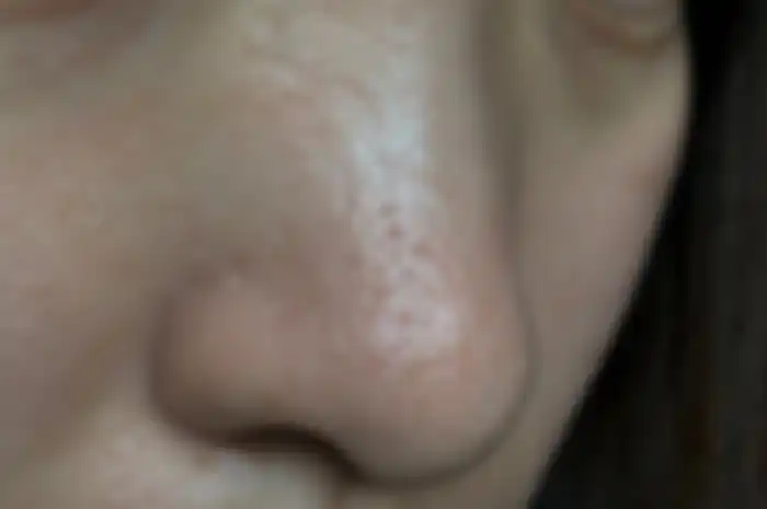 Ilustrasi pori besar di hidung