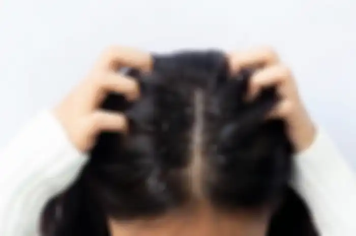 illustrasi rambut berketombe dan rontok