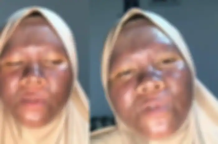 Viral di TikTok wajah seorang gadis berubah gosong setelah memakai krim pemutih.